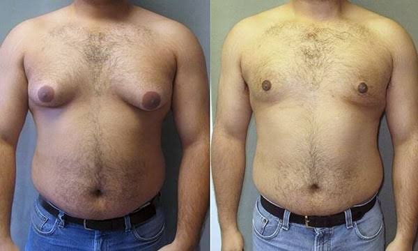 Homem confiante sem camisa, resultado do protocolo Peito Firme